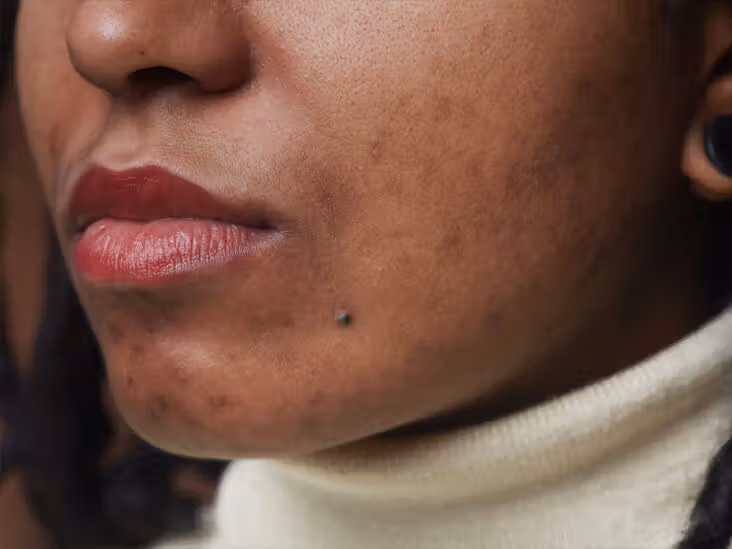 Birth Control Pill for Acne